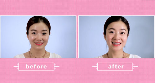 別讓“大黃牙”毀了你的形象，如何變白呢？ 聽王凱院長解答