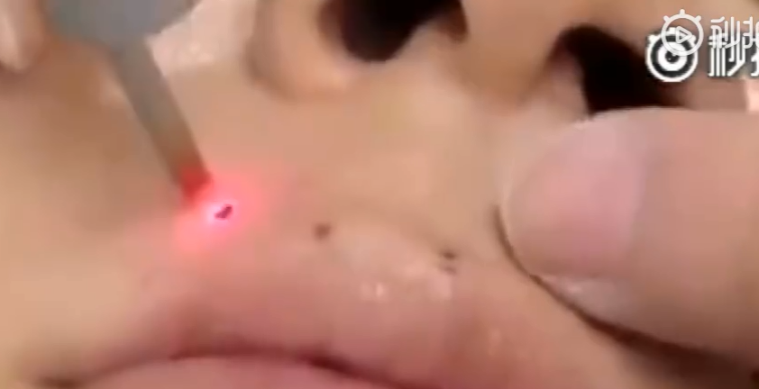 天津美萊祛斑， 新技能get