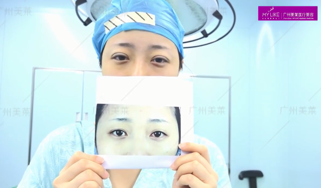 廣州美萊眼綜合，真人對比效果