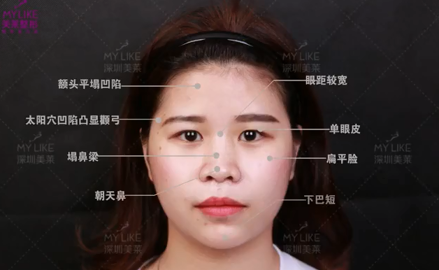 深圳美萊眼神全面改善，整體效果才能大大加分！
