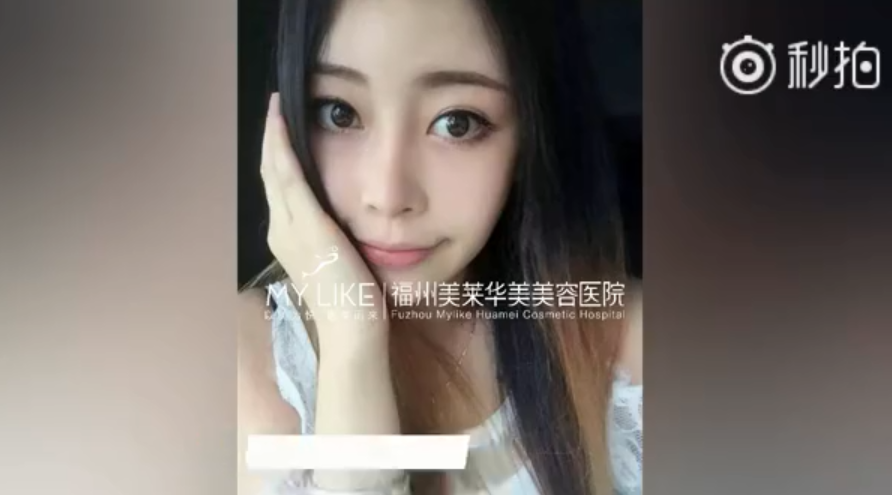 福州美萊鼻子幾毫米的改變，自信百倍的蛻變