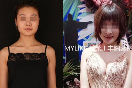 <a href='/zz/' target='_blank'><u>鄭州美萊</u></a>整形假體豐胸和自體豐胸哪個(gè)好？