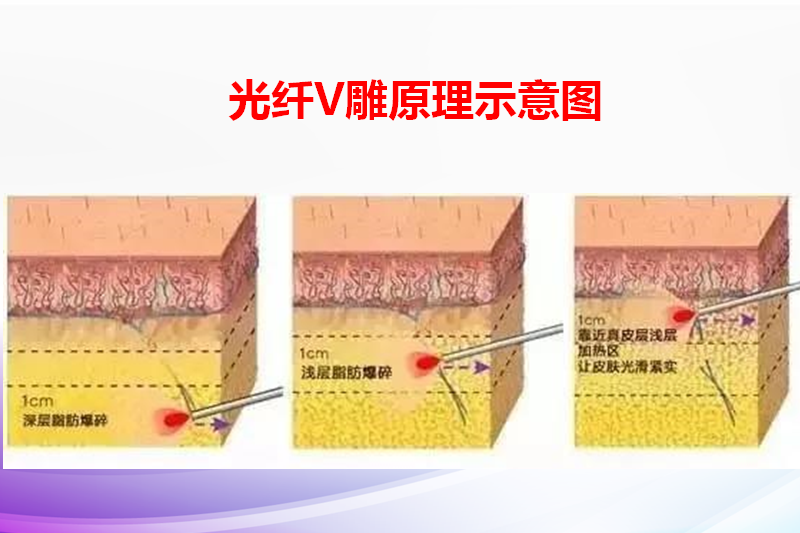 <a href='/zz/' target='_blank'><u>鄭州美萊</u></a> 光纖V雕&nbsp; 抗衰祛疤新方法