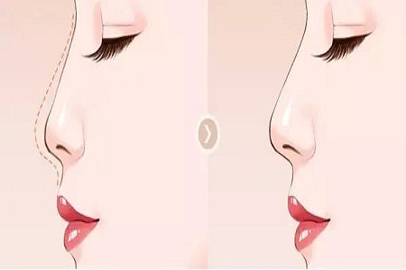 <a href='/sh' target='_blank'><u>上海美萊</u></a>*雕隆鼻多少錢