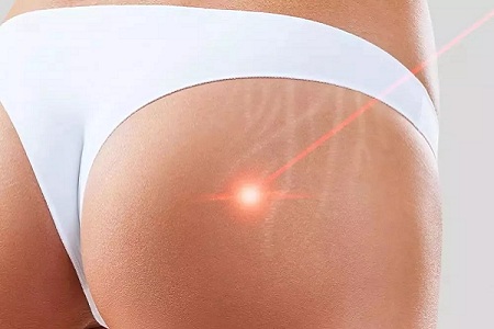 <a href='/gy/' target='_blank'><u>貴陽美萊</u></a>臀部吸脂減肥費用是多少