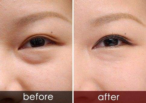 深圳美萊祛除眼袋的好辦法是什么？