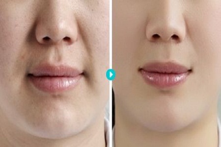 法令紋價(jià)格是多少 一招幫你解決老氣橫秋