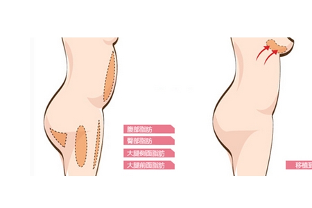 曲靖自體脂肪豐胸維持多久？有哪些優(yōu)點(diǎn)