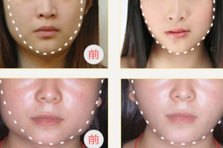 曲靖改臉型多少錢？影響因素有哪些