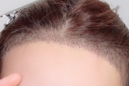 常州發(fā)際線調(diào)整效果好嗎，發(fā)際線如何調(diào)整？