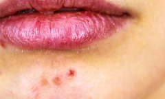 廣州哪家醫(yī)院做激光去痘痘手術(shù)好，激光祛痘大概需要多少錢