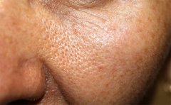 毛孔粗大要怎么辦，有沒有推薦的項目