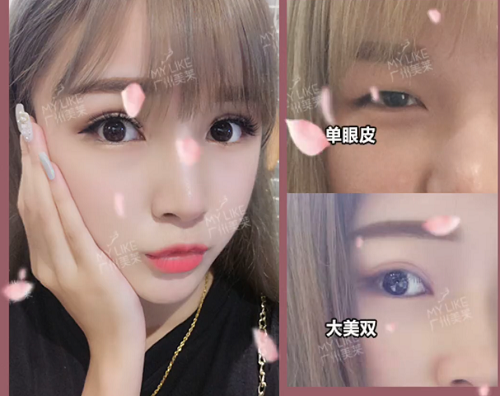 廣州美萊9大雙眼皮模板，你pick哪款？