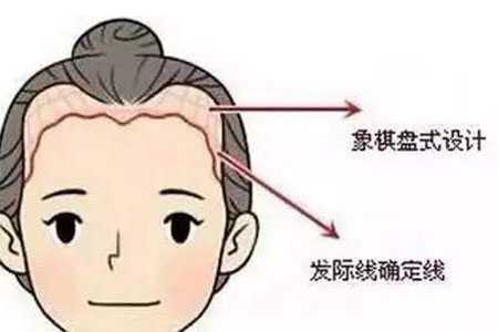 石家莊做發(fā)際線調(diào)整手術價格貴嗎